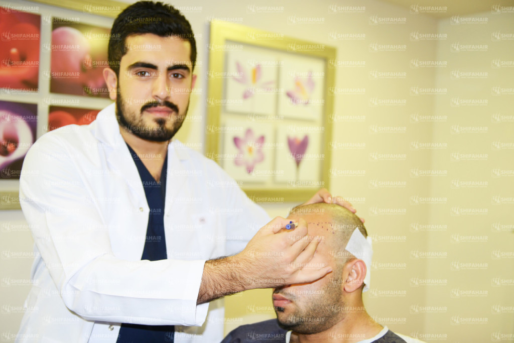 hair transplant