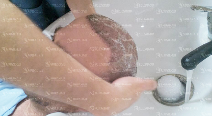 زراعة الشعر في تركيا