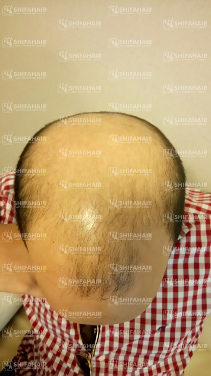 تجربة زراعة شعر لأحد العملاء قبل وبعد دار الشفاء لزراعة الشعر