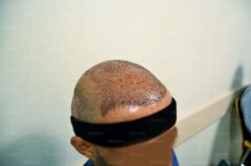 زراعة الشعر للرجال
